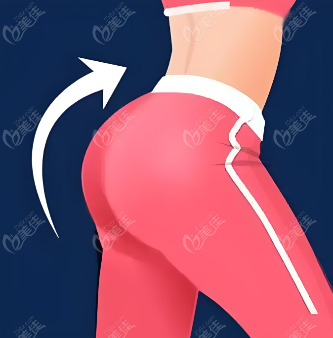 北京李奇軍蜂腰美臀術是什么