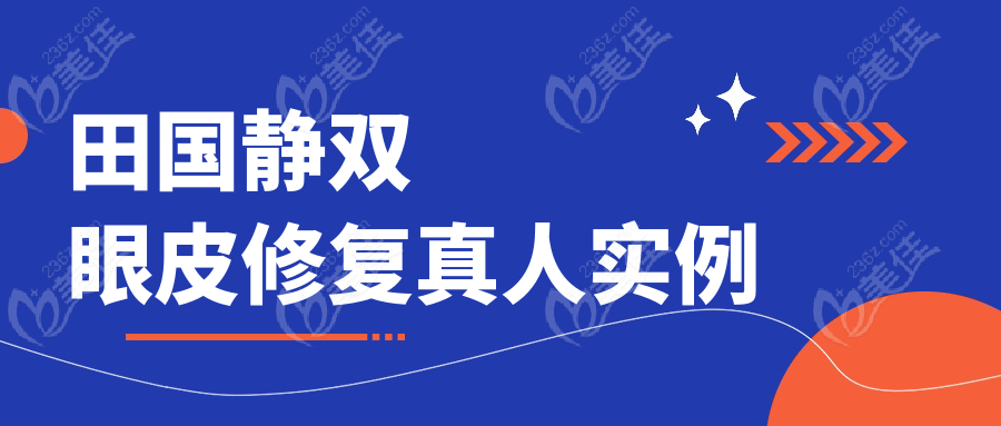 田国静双眼皮修复真人实例