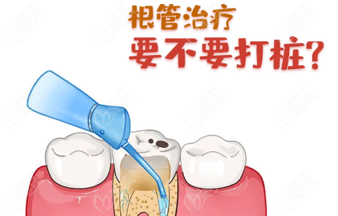 成都根管治疗价格消费指南：5 招节省治疗费用