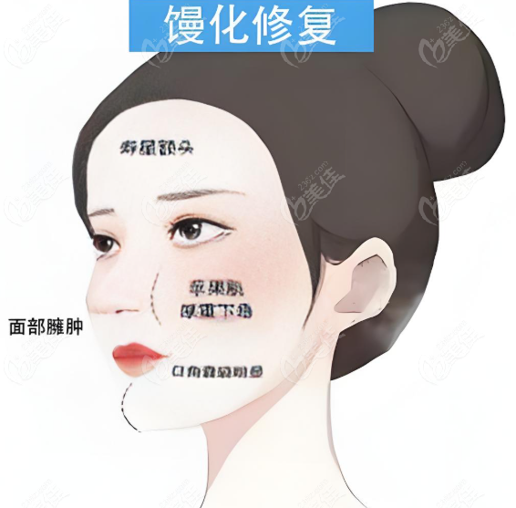 姬付康醫(yī)生饅化修復(fù)