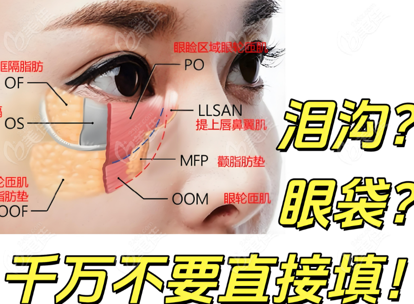 避免淚溝填充饅化示意圖