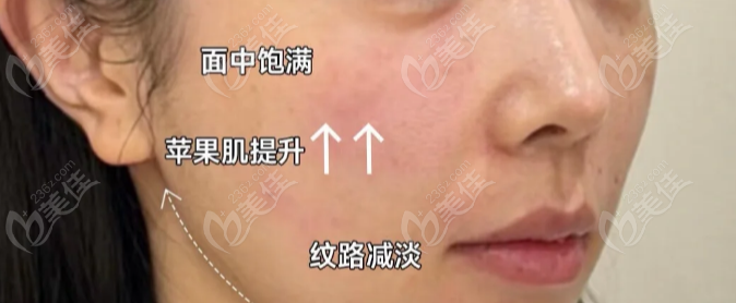 成都张艳峰脂肪室复位怎么样