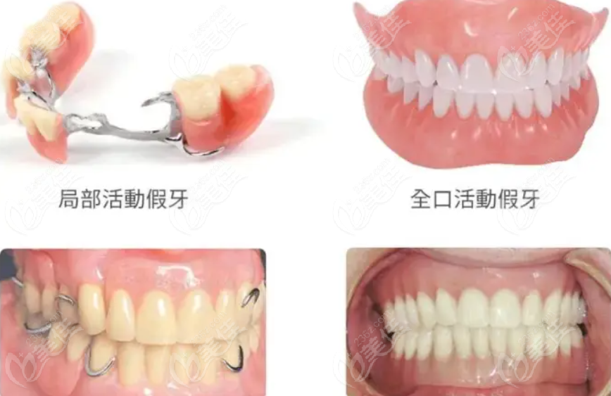 做全口活动假牙