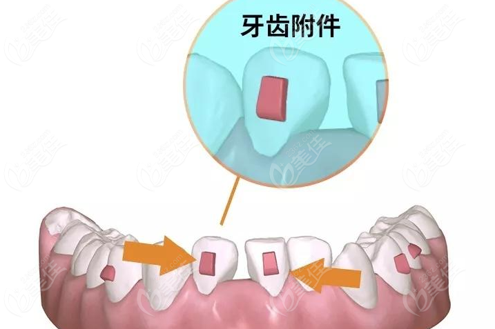 线上预约胥杨医生-可享隐形矫正8折优惠细则