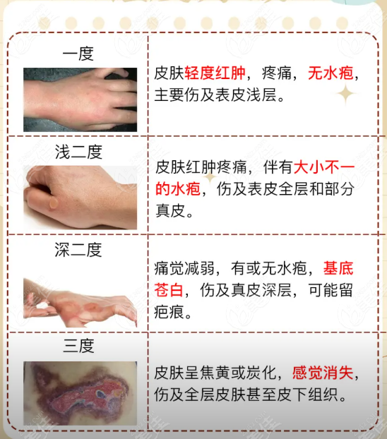 烧烫伤一度、浅二度、深二度、三度区别对比图
