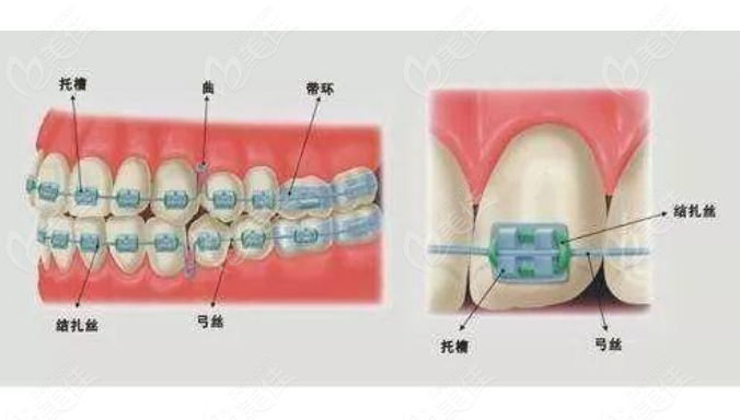 钢丝矫正牙齿