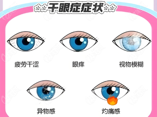 干眼症