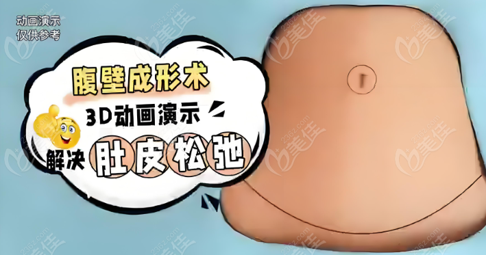 劉賓醫(yī)生做腹壁手術(shù)