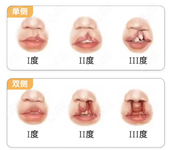 华西口腔石冰做唇裂预约挂号方式