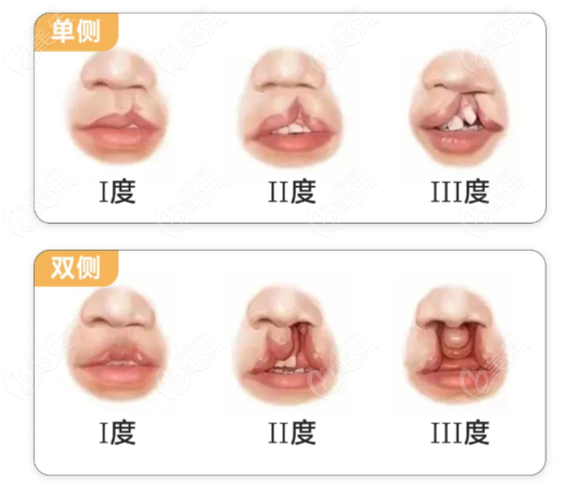 石冰做唇裂及腭裂的成功实例图片