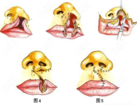 陈国鼎唇裂修复技术好