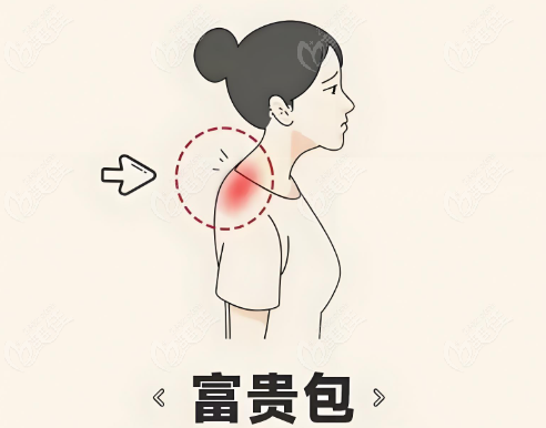 黄学峰一针去富贵包技术