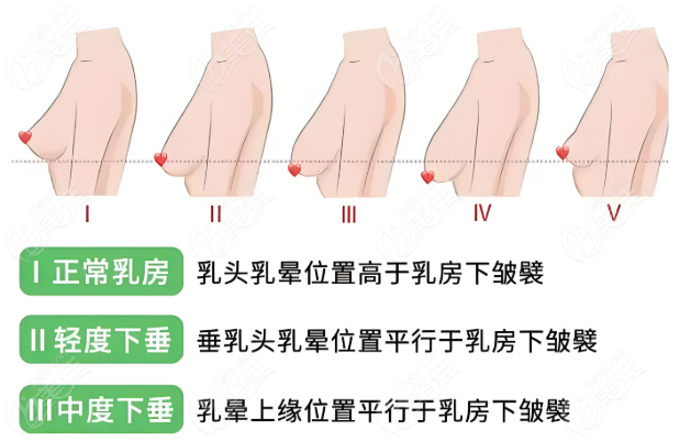 胸部下垂狀態介紹