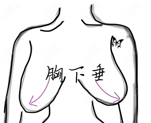 乳房懸吊術后會留疤嗎