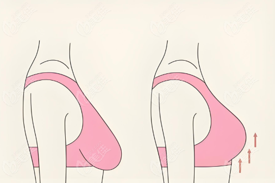 國內乳房懸吊哪個醫生好