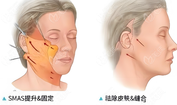 拉皮提升m.xqnp.cn