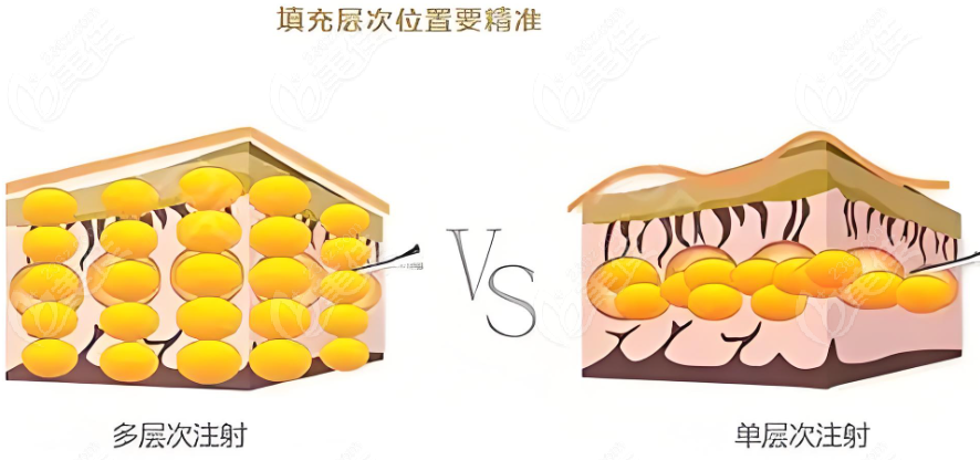 脂肪填充手術(shù)m.xqnp.cn