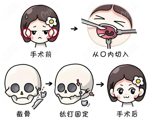 楊君毅醫生顴骨內推