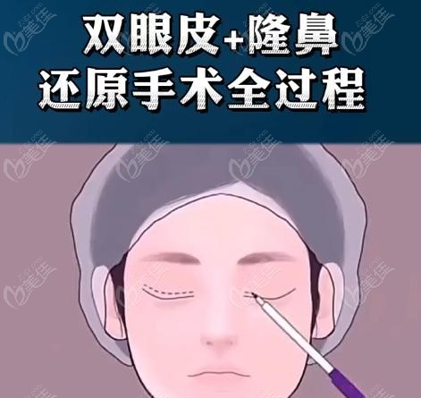 张大艳双眼皮无失败实例