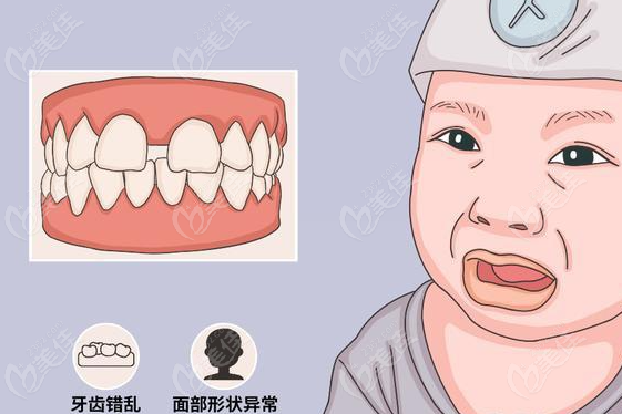 bionator功能矯治器的介紹適應(yīng)癥