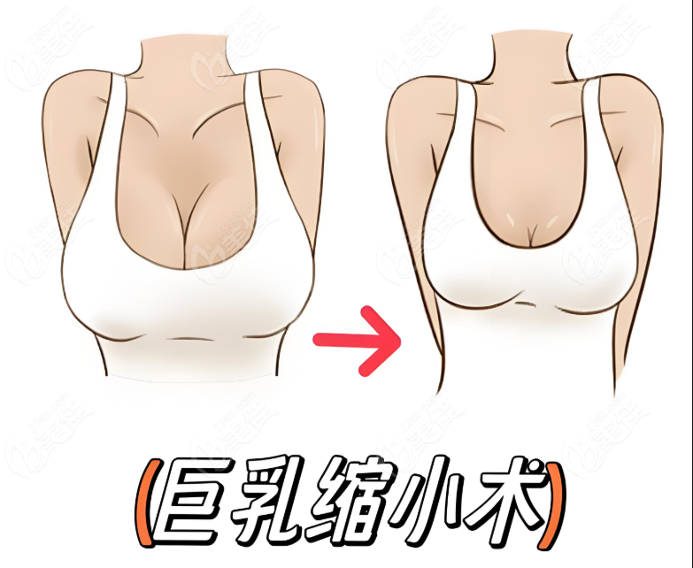 巨乳缩小术对比图