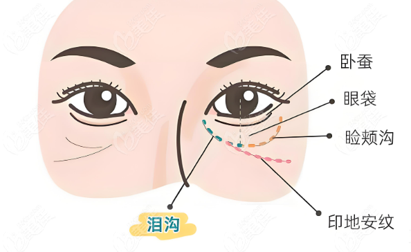 膠原蛋白填淚溝
