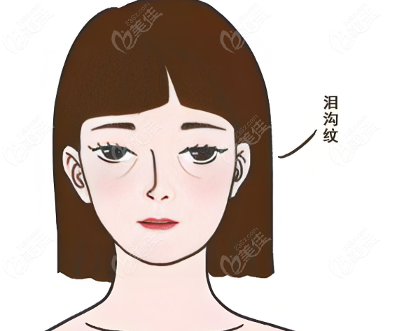 上海膠原蛋白填淚溝
