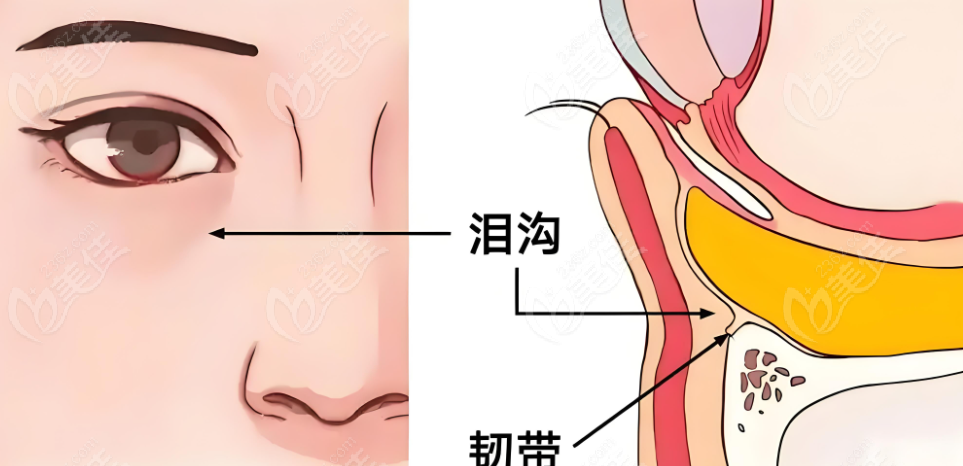 填充泪沟示意图
