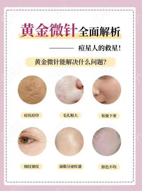 北京黃金微針美容醫(yī)院推薦