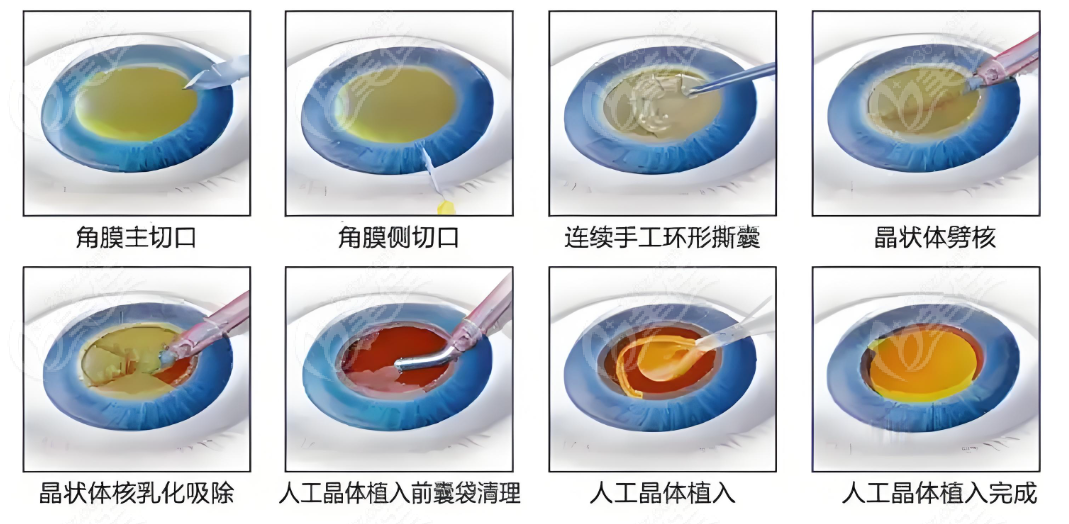 武汉白内障手术