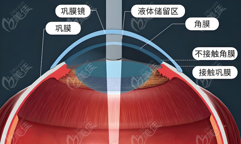 圆锥角膜治疗