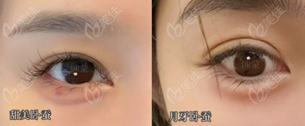 臥蠶打什么牌子的玻尿酸好