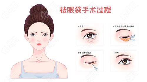 不开刀无痕无针祛眼袋手术靠谱