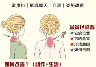 微创去富贵包