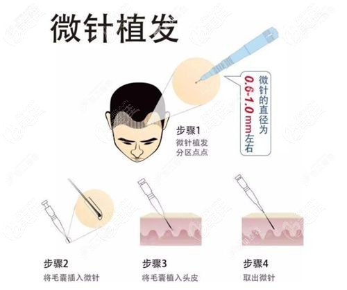 南京领秀植发医院植发技术实力强