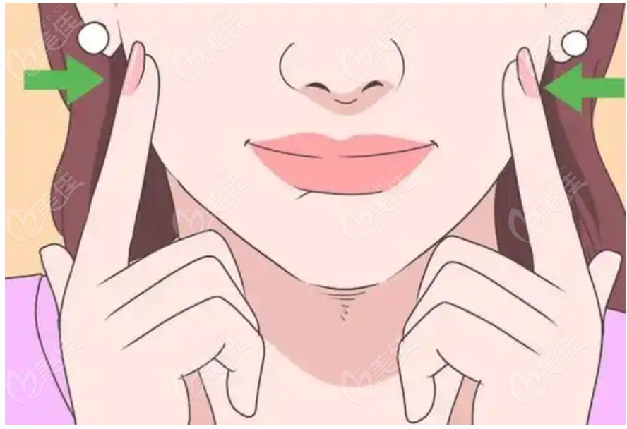 法令纹修复