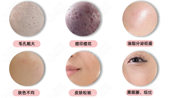 重庆黄金微针美肤还能干啥