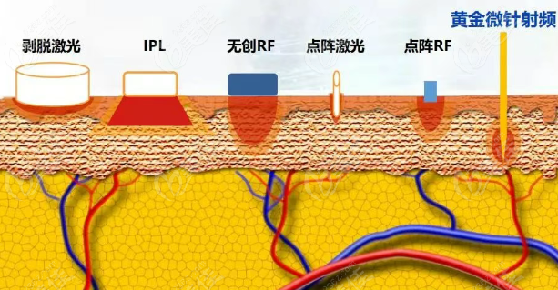 重庆黄金微针美肤体验大不同