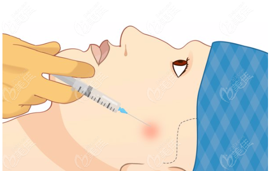 注射醫(yī)美m.pfflawyer.com 注射醫(yī)美m.pfflawyer.com