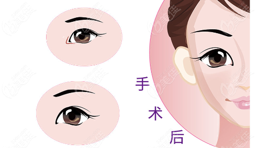 双眼皮手术www.236z.com