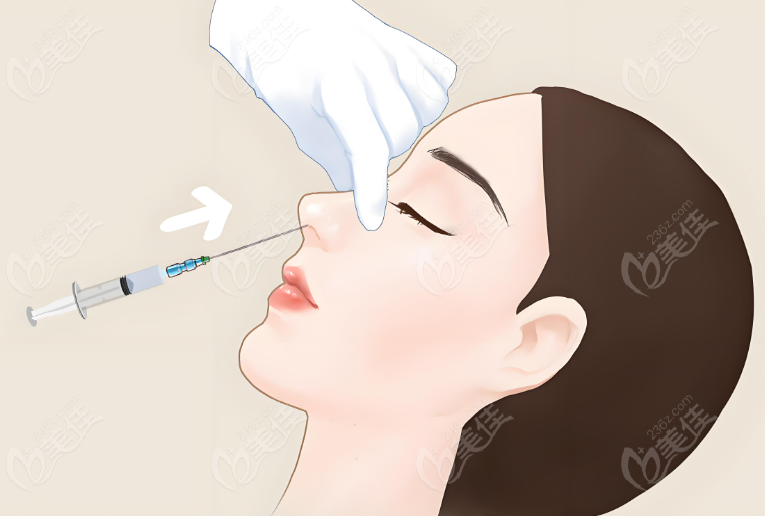 注射隆鼻