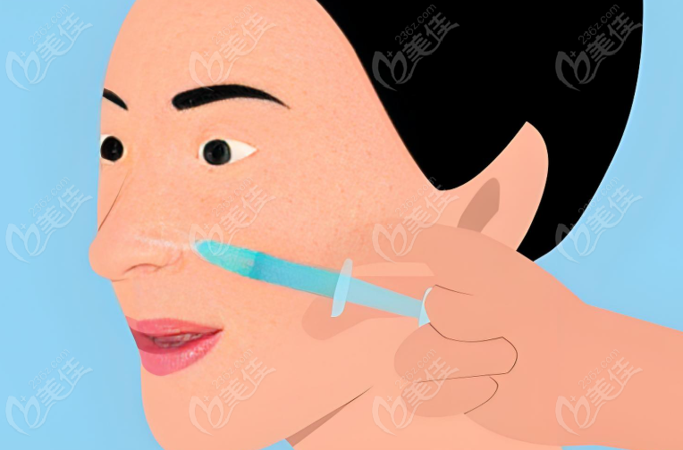 注射玻尿酸隆鼻示意圖