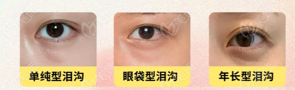 成都填充淚溝比較好的醫(yī)院