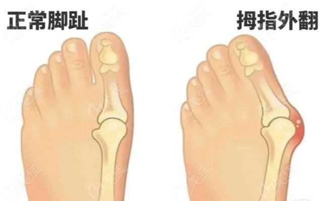 陳圣英在哪個醫(yī)院做拇外翻手術(shù)