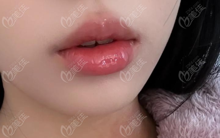 瑞藍2號打嘴唇能維持多久