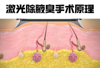 激光祛狐臭