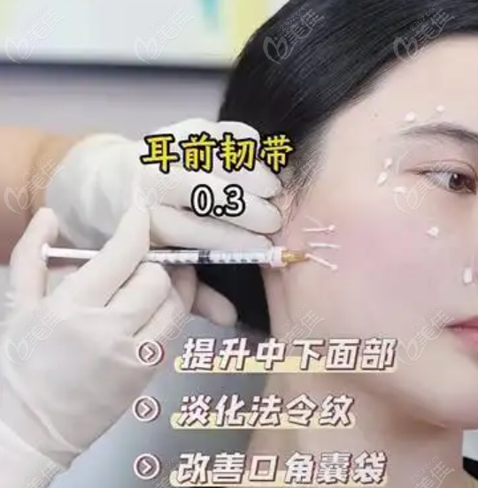 耳前韌帶提升點(diǎn)位圖揭秘