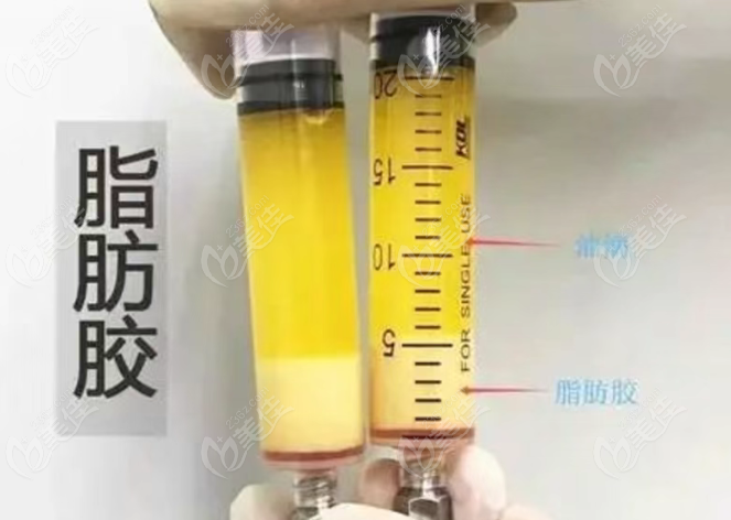 刘彦龙医生脂肪胶注射增粗