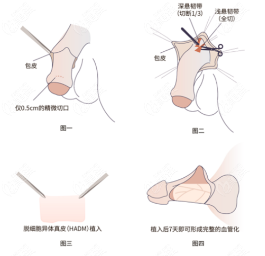 李世荣延长手术价格表