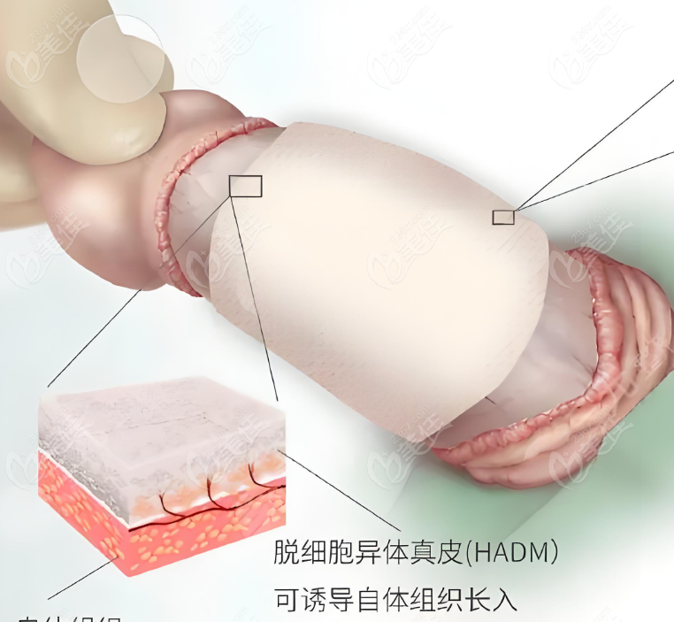 李世荣做完手术的感觉